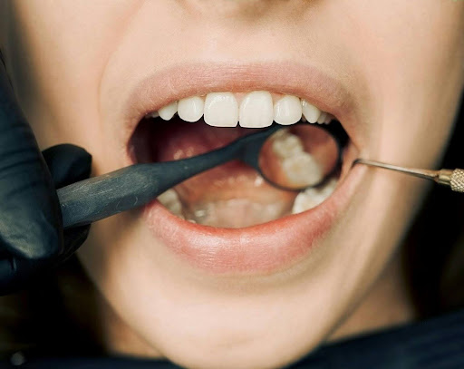 Invisalign