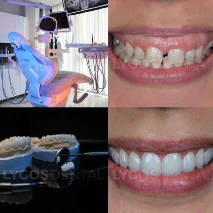 Why Istanbul Has Become the Preferred Destination for Smile Makeovers ?