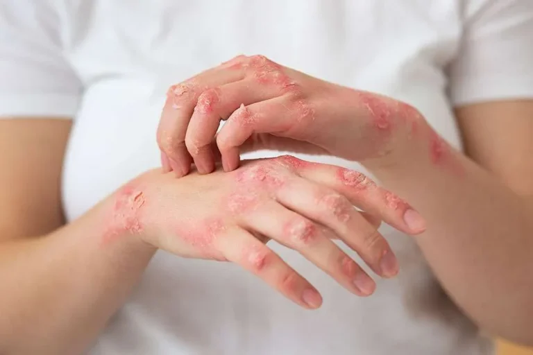 How Natural Skin Remedies Are Helping Australians Manage Psoriasis More Confidently