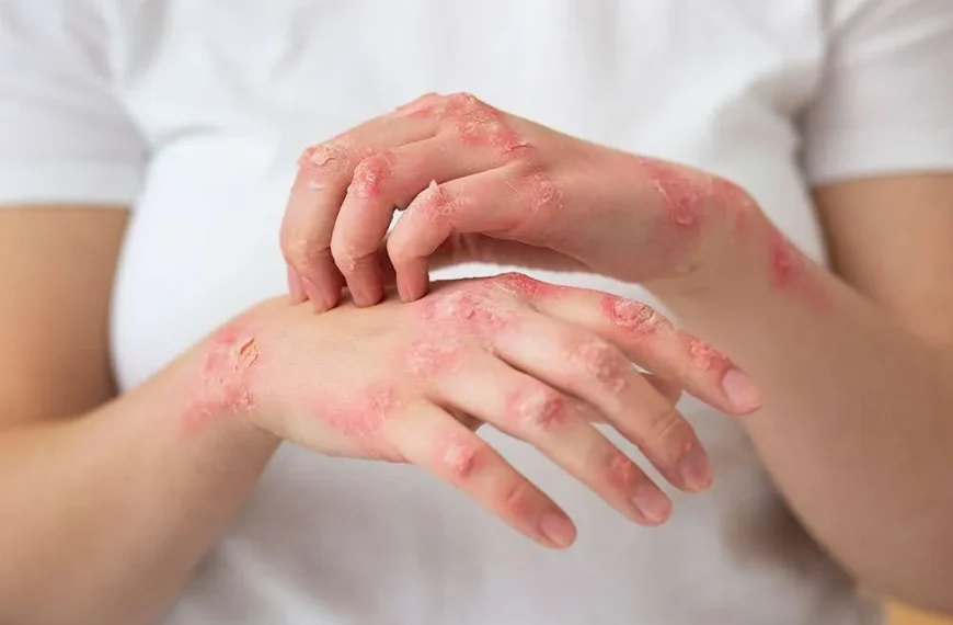 How Natural Skin Remedies Are Helping Australians Manage Psoriasis More Confidently