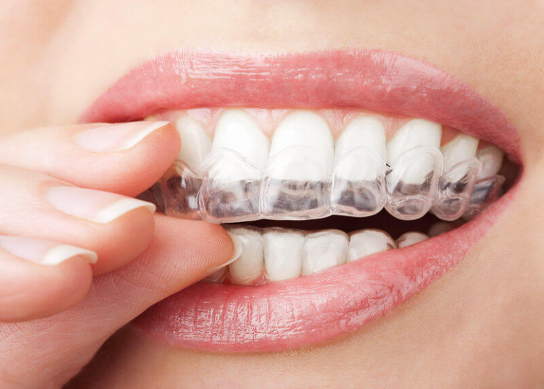 Invisalign Hillsboro