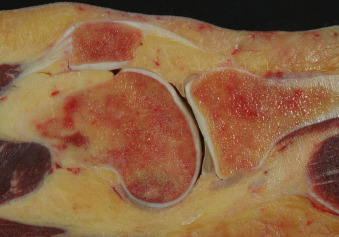 Bone Marrow Lesions